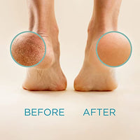 Lee Beauty Professional Callus Remover for Feet - 8 Oz, Original, Powerful Formulation - Extra Strength Gel, Home Pedicure Foot Spa Results - Cracked & Dead Dry Skin Supplies